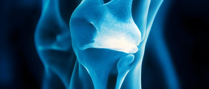 47. A human knee X-ray showing meniscus tears 47. A human knee X-ray showing meniscus tears