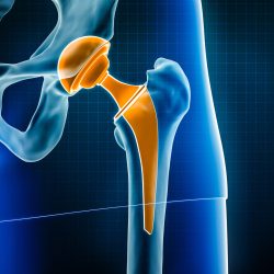 Hip prosthesis x-ray 3D rendering illustration. Total hip joint replacement surgery or arthroplasty, medical and healthcare, arthritis, pathology, science, osteology, orthopedics concepts. Hip prosthesis x-ray 3D rendering illustration. Total hip joint replacement surgery or arthroplasty, medical and healthcare, arthritis, pathology, science, osteology, orthopedics concepts.